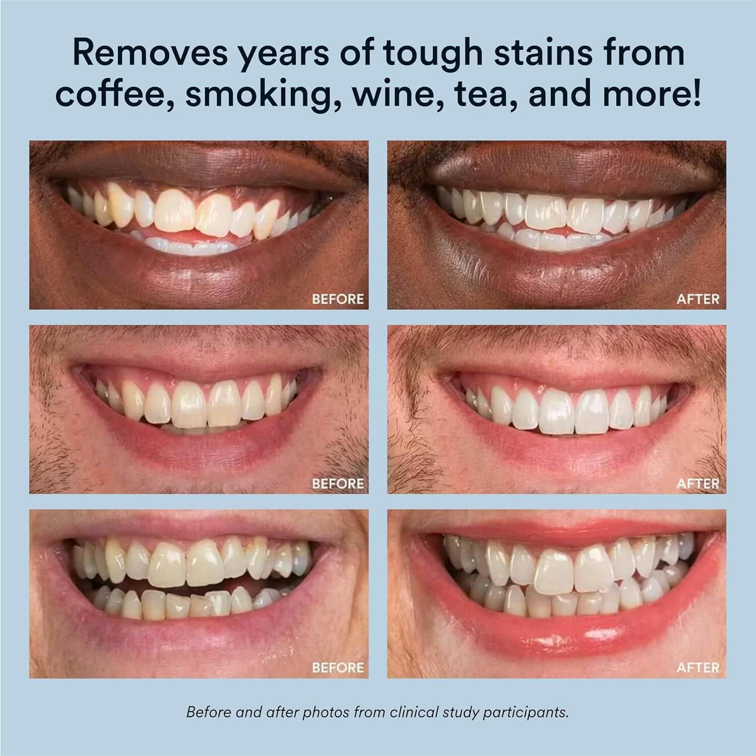 Auraglow Teeth Whitening Pen